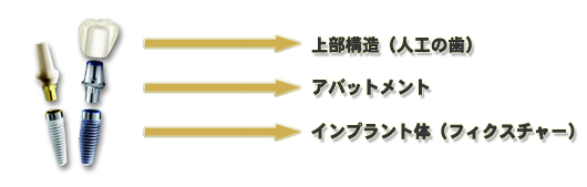 インプラントの構造 上部構造(人工の歯)、アバットメント、インプラント体(フィクスチャー)