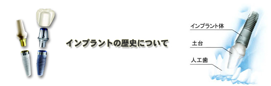 インプラントの歴史について