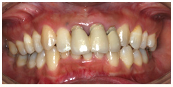 (インプラント症例)主訴 虫歯の治療と左上６の欠損　男性４７歳