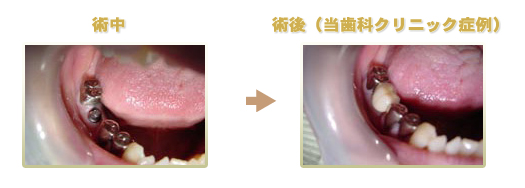 歯を一本だけ失った場合 術中、術後